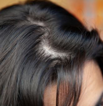 how to get rid of greasy hair